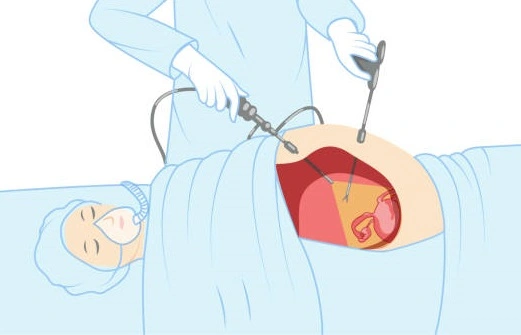 What is hernia repair surgery in female?